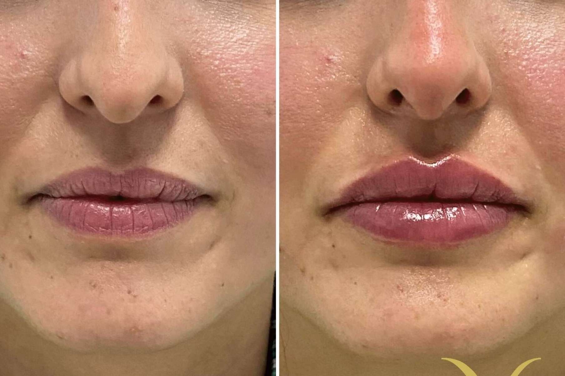 La técnica de la Clínica Yasmin para el aumento de labios con ácido hialurónico, Adiblips