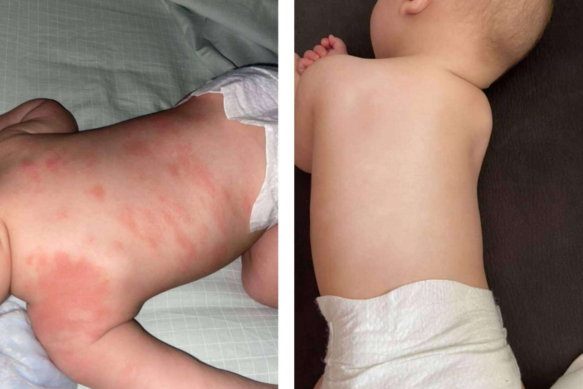 El antes y después de emplear la crema hidratante en pieles atópicas creada por Green Cornerss