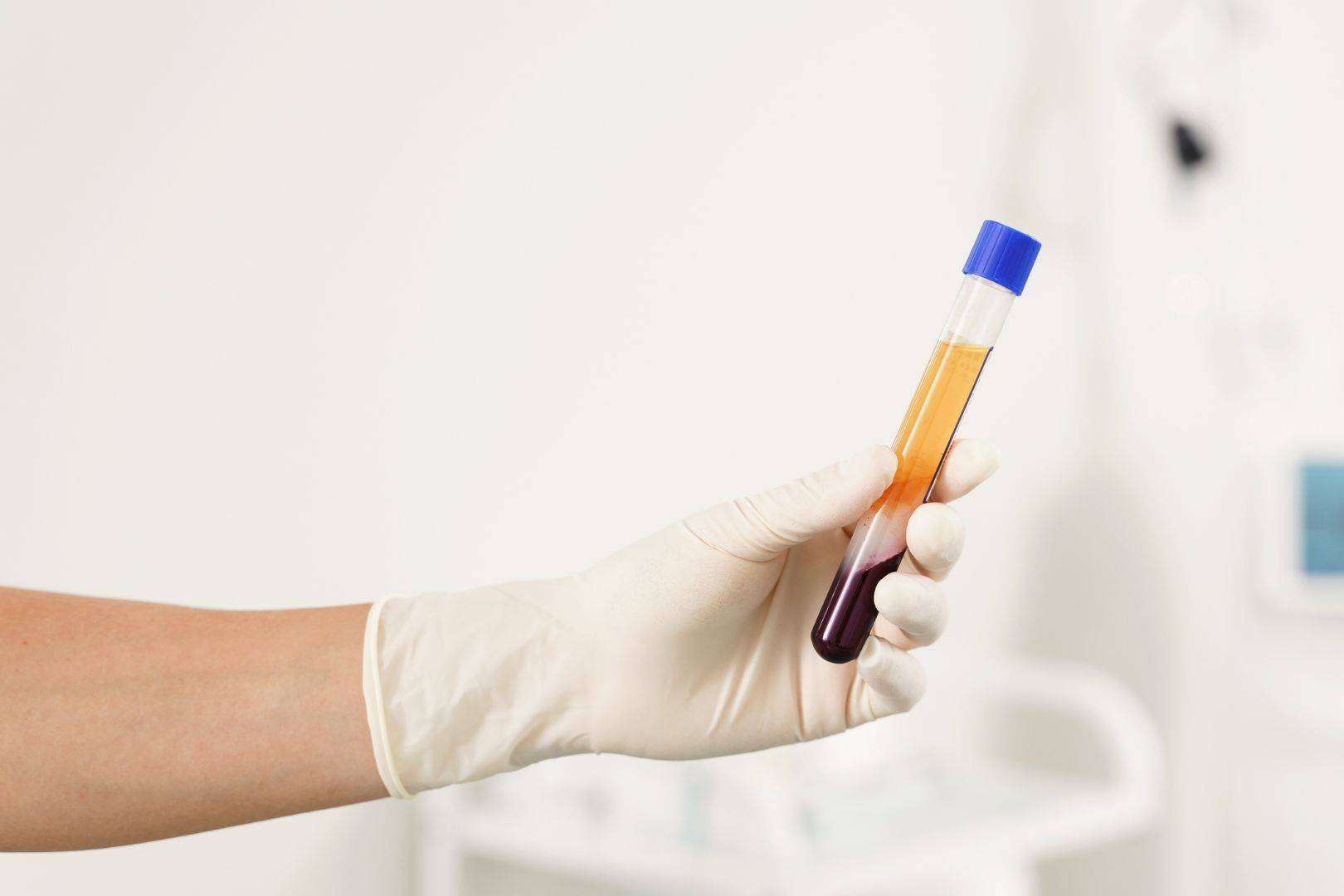 El plasma rico en plaquetas y dutasterida es una potente terapia regenerativa de doble efecto contra la caída del cabello