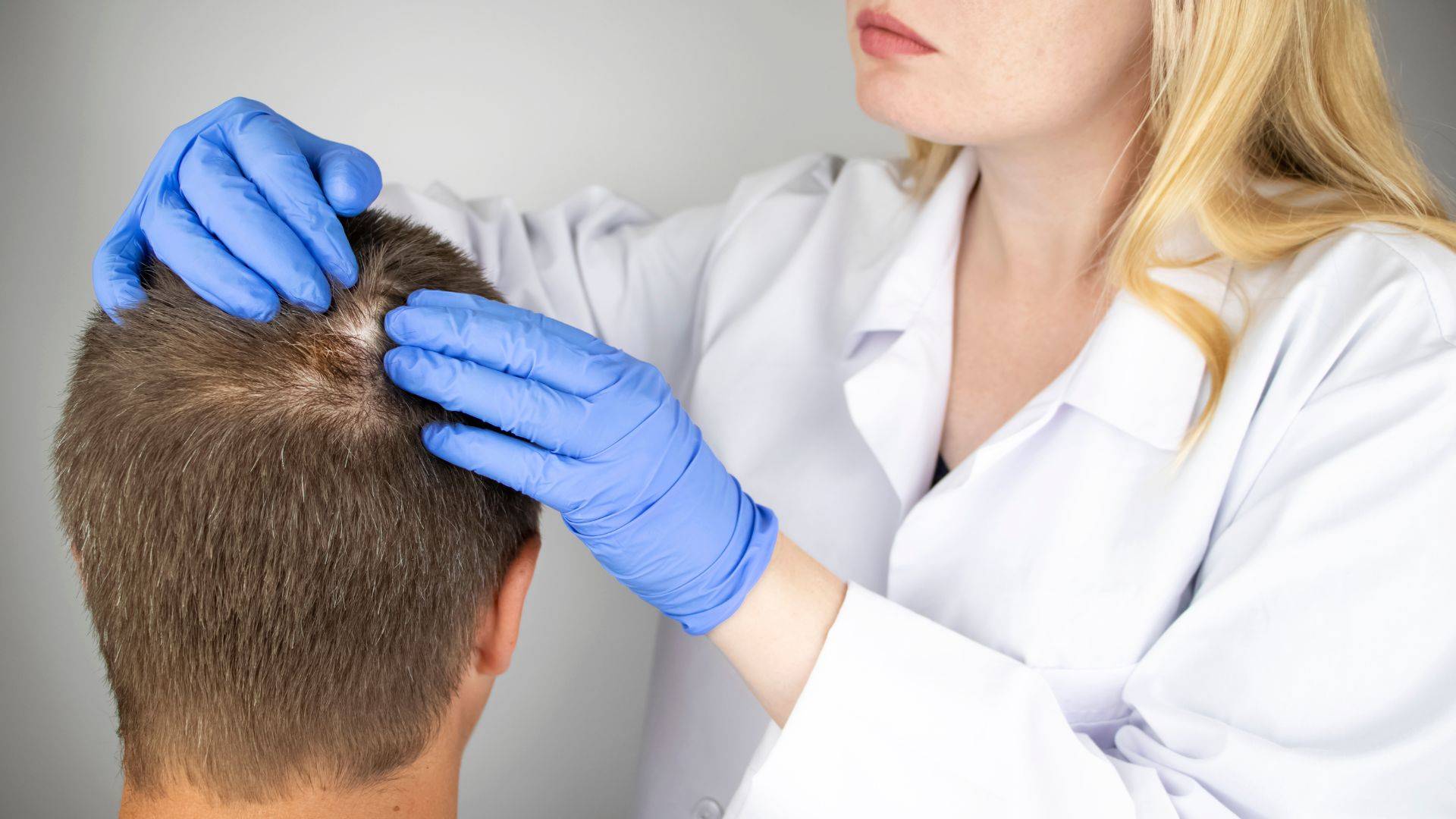 ¿Pueden contagiar los perros la alopecia por tiña del cuero cabelludo?
