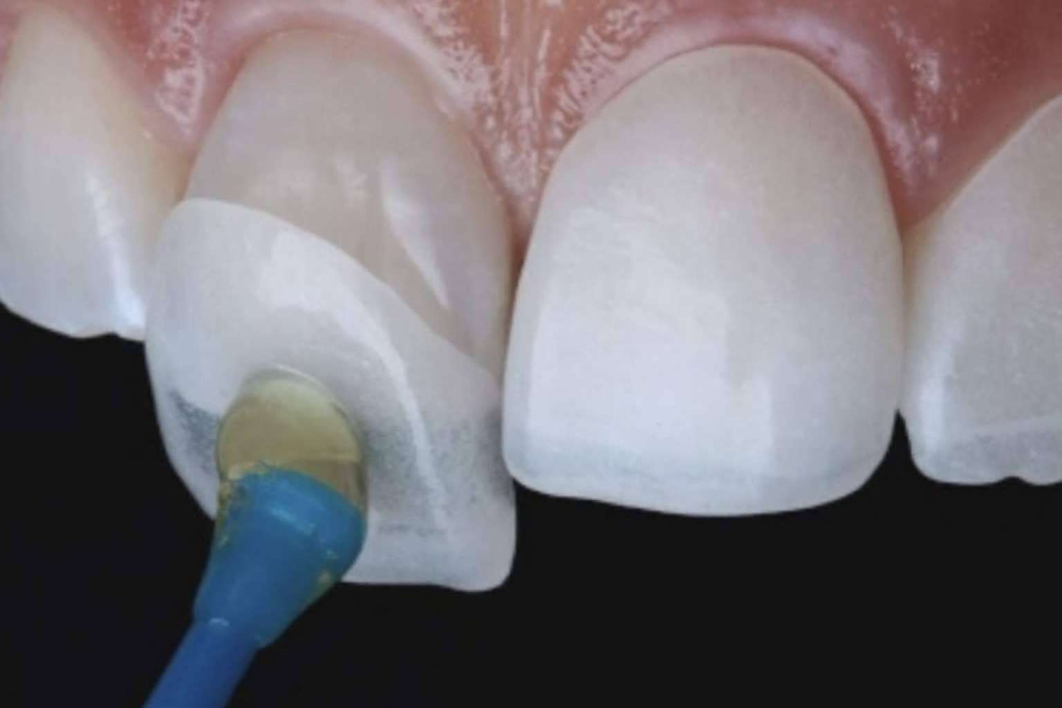 Información sobre el tratamiento de carillas dentales de esta clínica dental de Chamartín