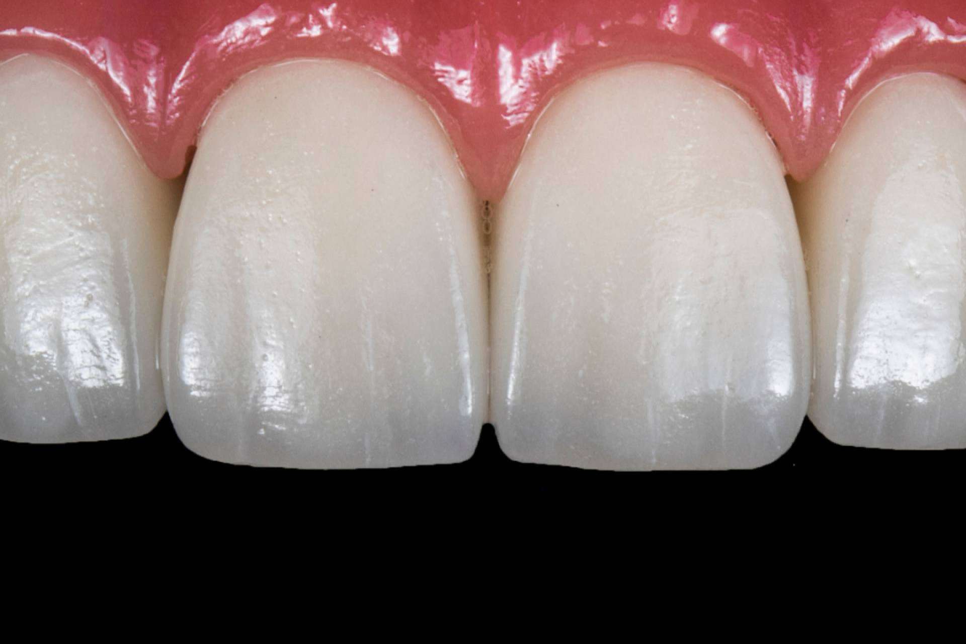Corporación Dental lleva a cabo implantes de carga inmediata en Antequera