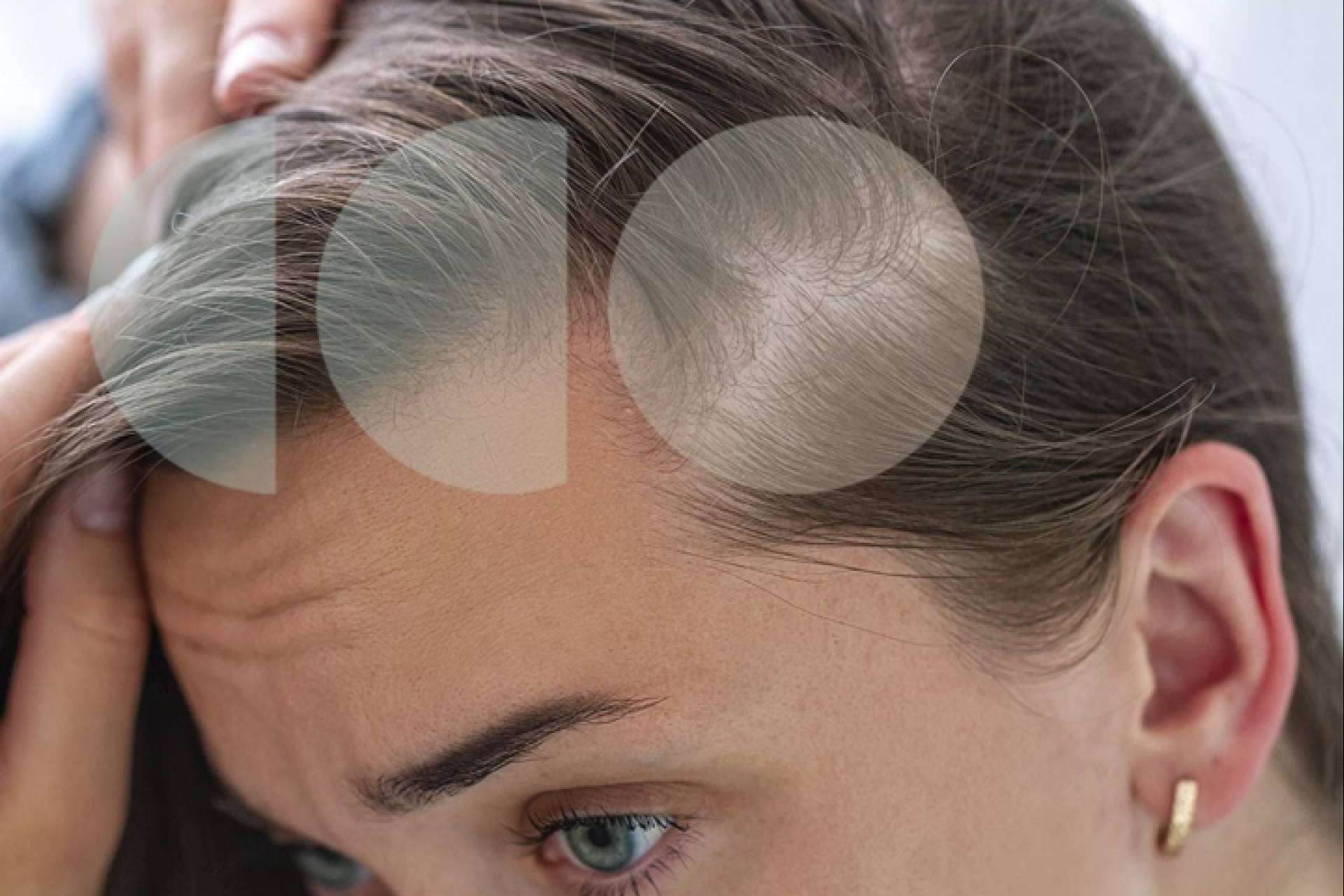Este año la caída de cabello estacional viene más fuerte