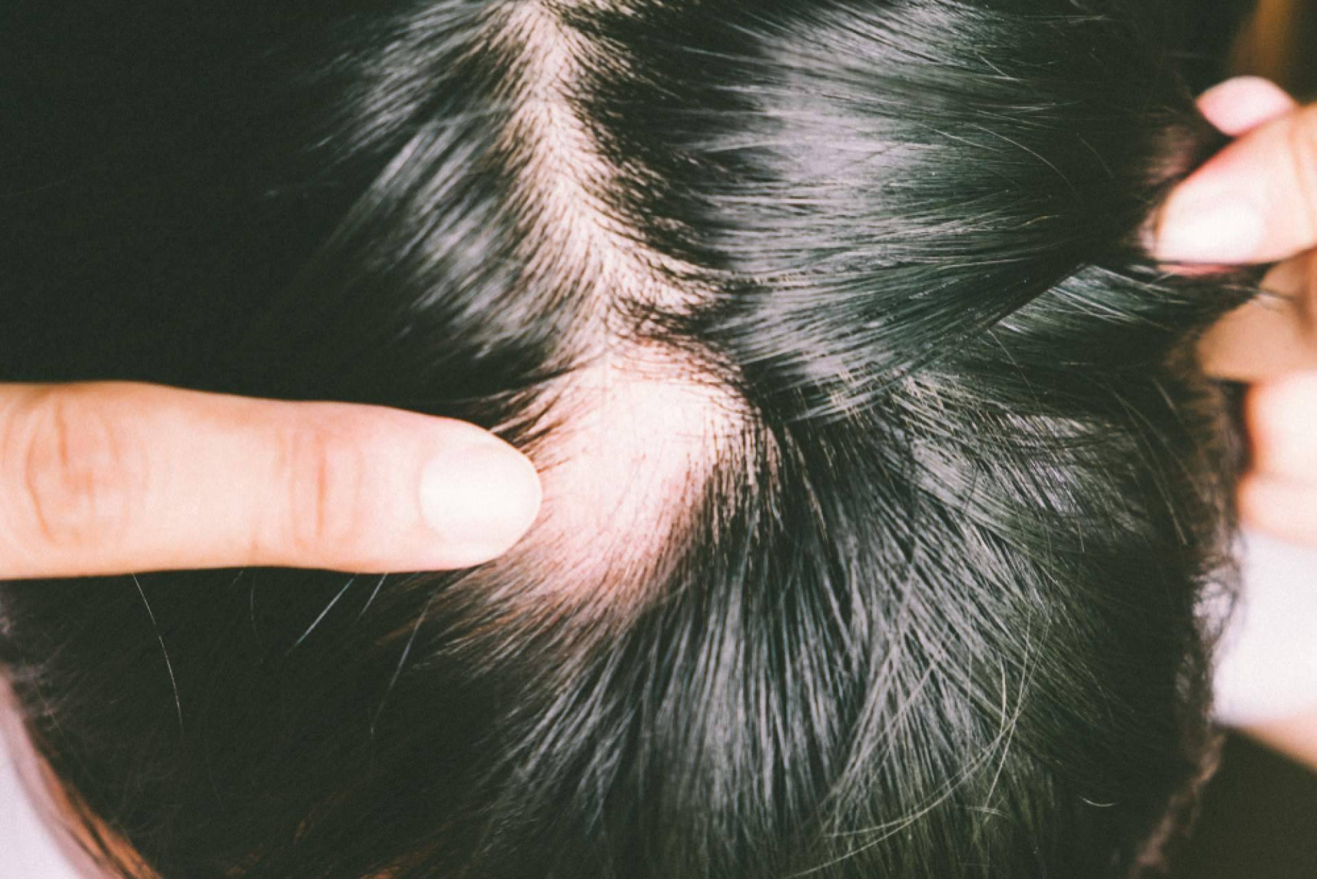 En qué consiste la alopecia areata y cómo disminuirla