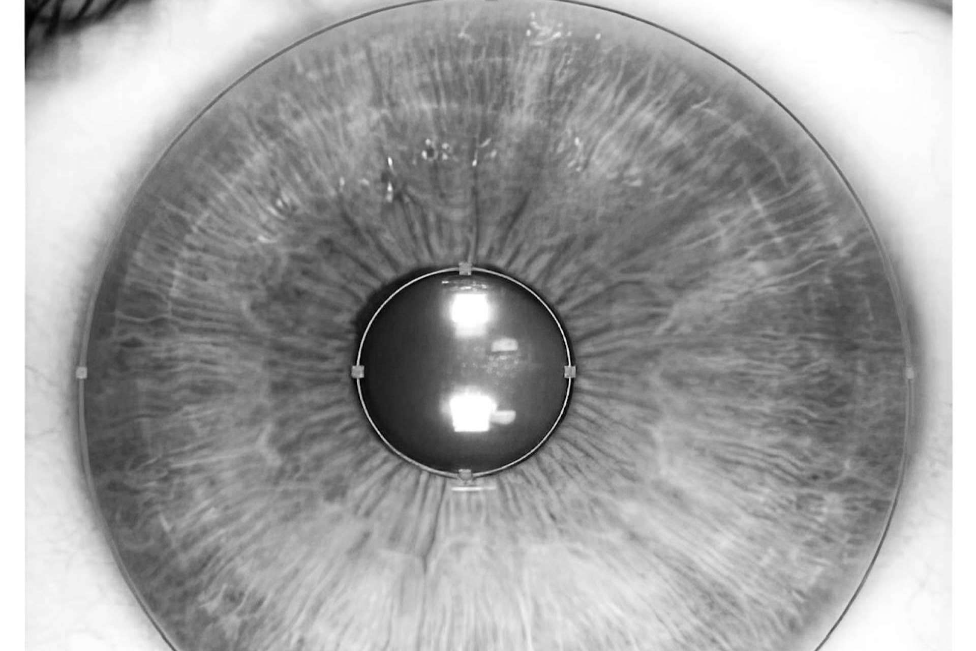 Los beneficios de la tecnología láser para cambiar el color de ojos