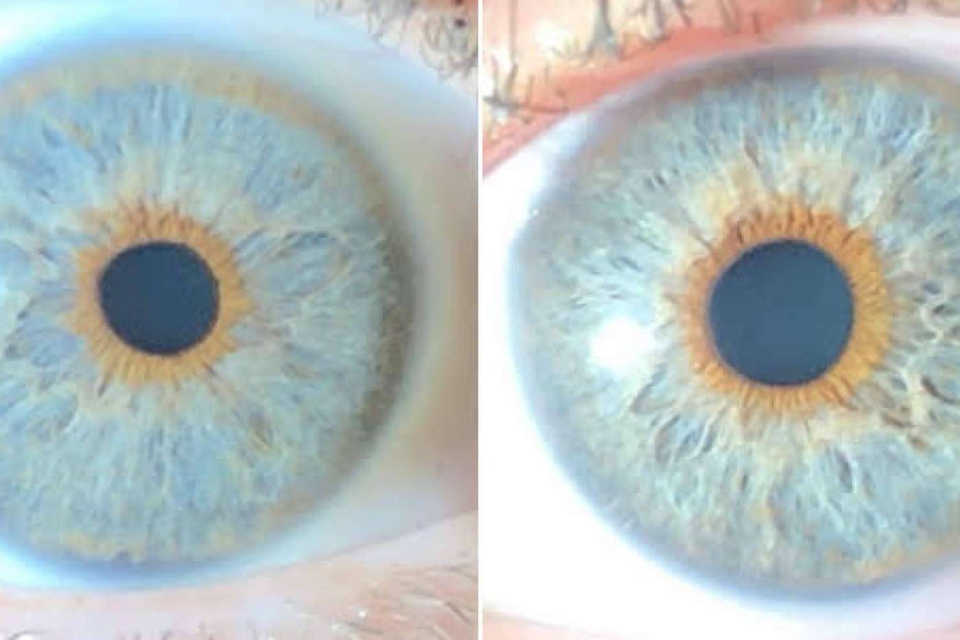 Clínica Eyecos y los avances en las operaciones de cambio de color de ojos con láser