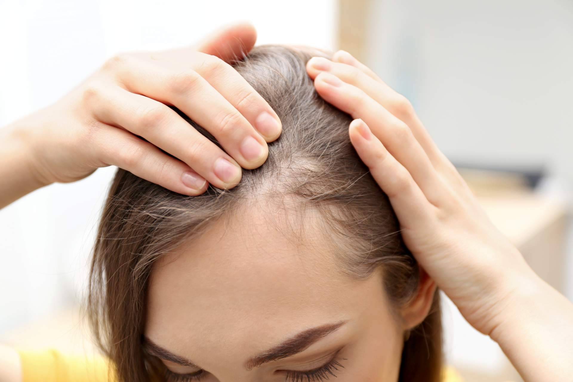 El método de Capilar Innovation Clinic para combatir la alopecia femenina