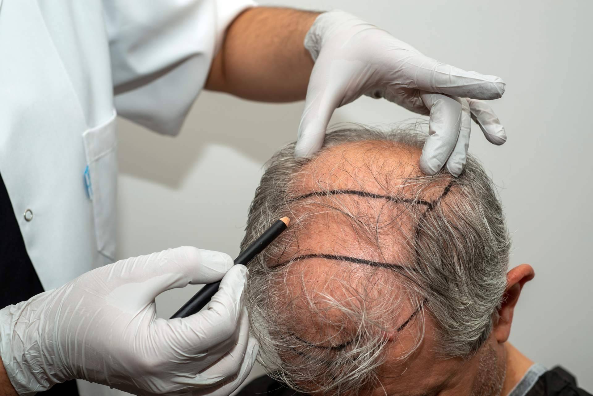 Microinjerto capilar FUE, solución definitiva y mínimamente invasiva para la alopecia androgénica