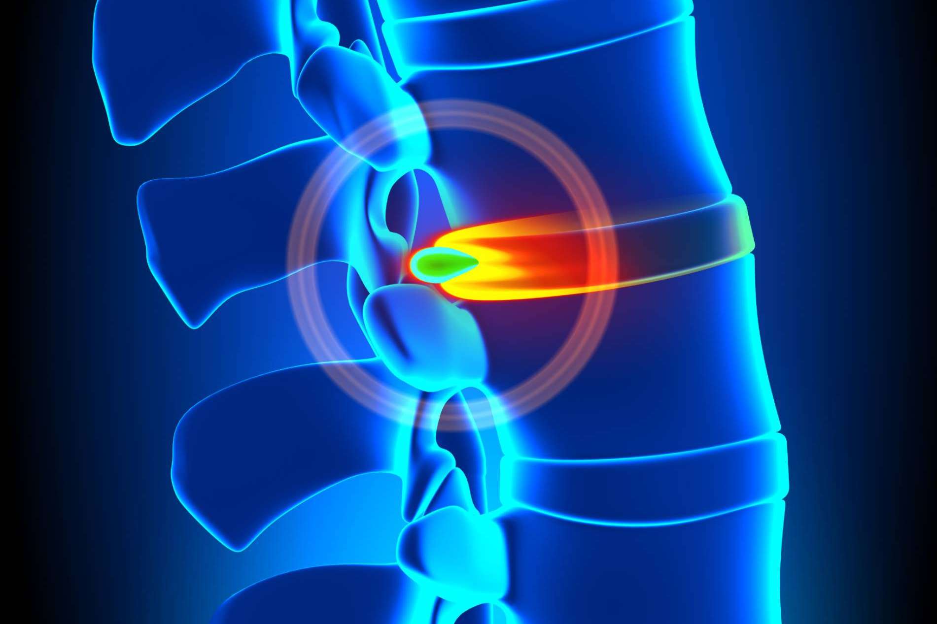 La andulación, un enfoque terapéutico innovador para casos de hernia discal
