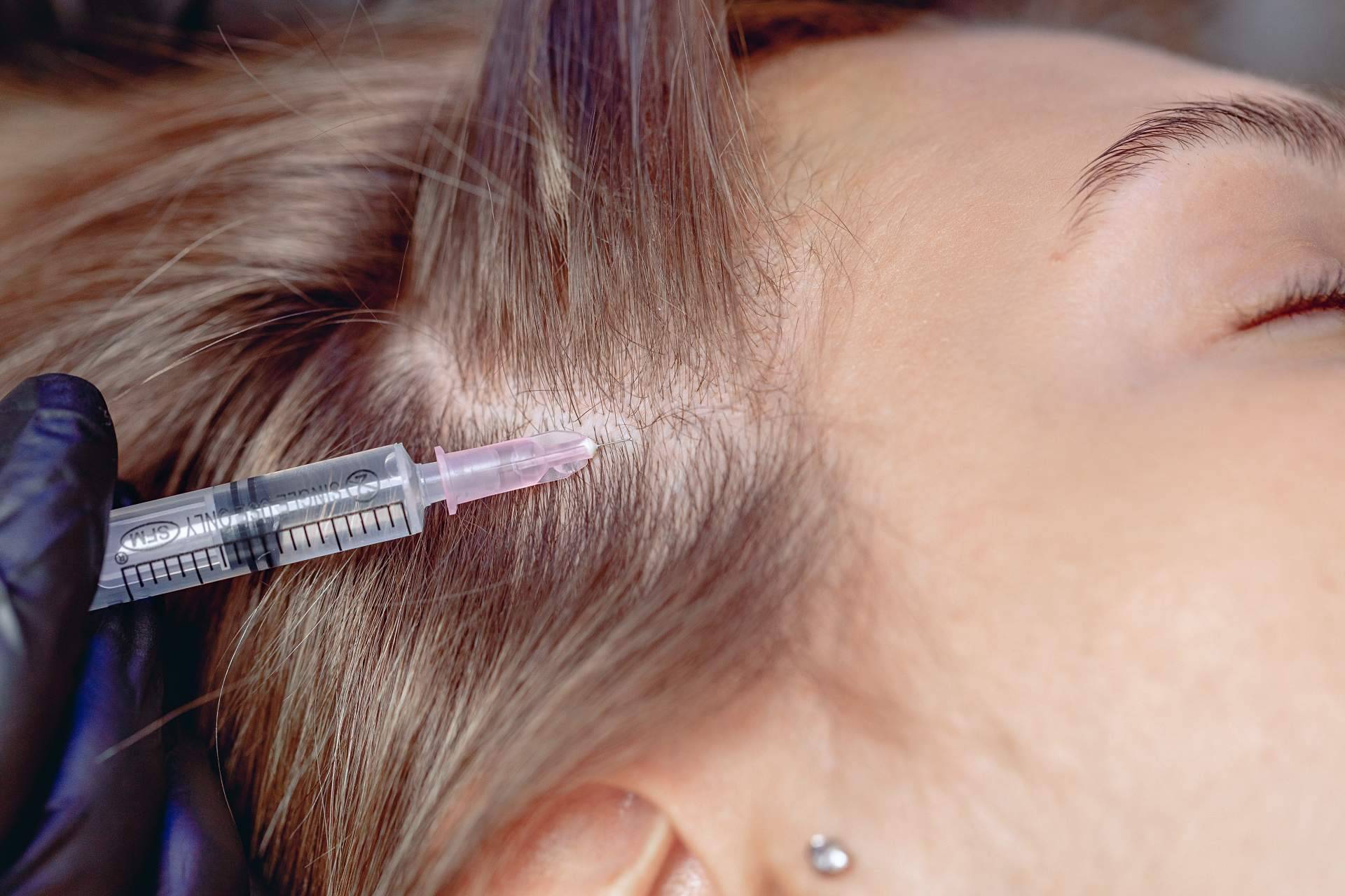 Tratamientos de mesoterapia para el cabello de la mano de Capilar Innovation Clinic, con el doctor Jesus Anibal Mora