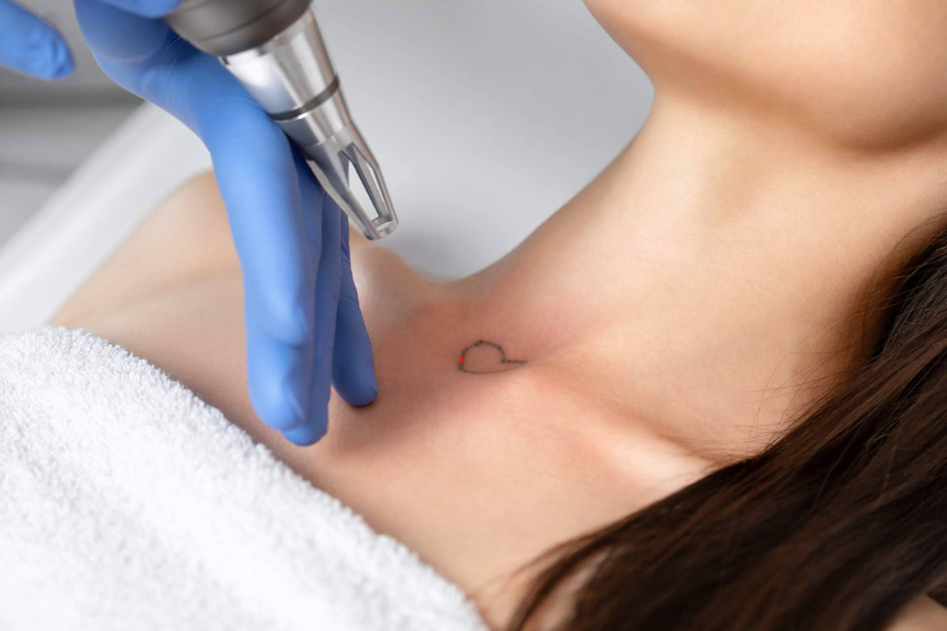 ¿Se pueden eliminar tatuajes a color? Todo lo que ofrece Ink Láser Alicante