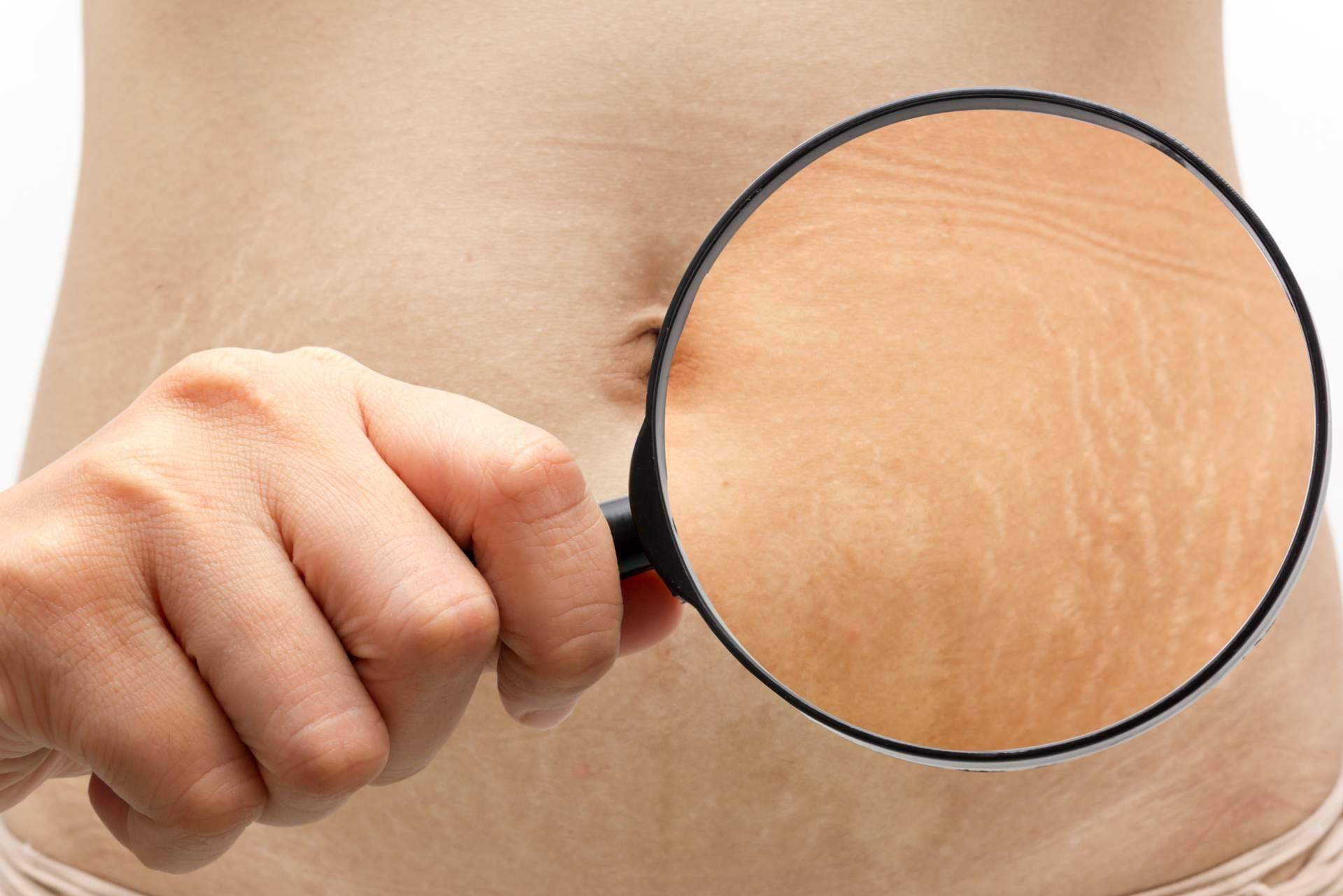 ¿Cómo quitar estrías con un tratamiento indoloro y no invasivo? Centro Estética el Pilar