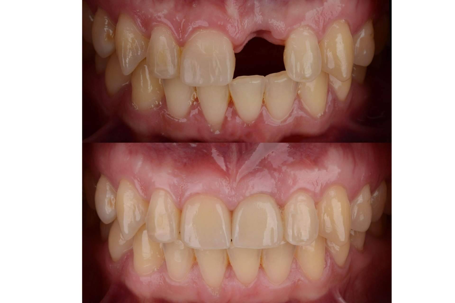 Las ventajas de un implante dental en DeltaDent