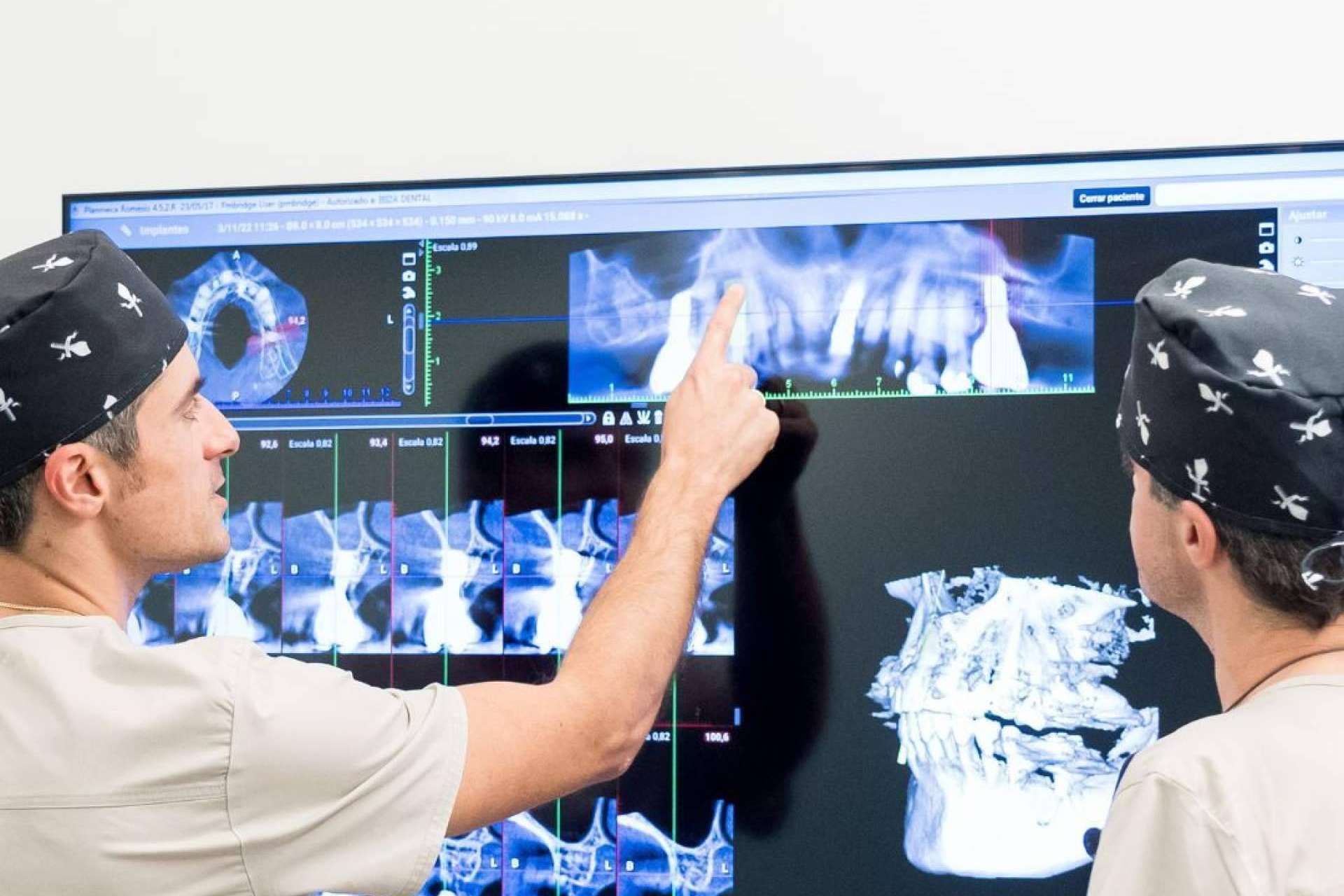 Beneficios de los implantes All on 4, una innovadora técnica de restauración dental