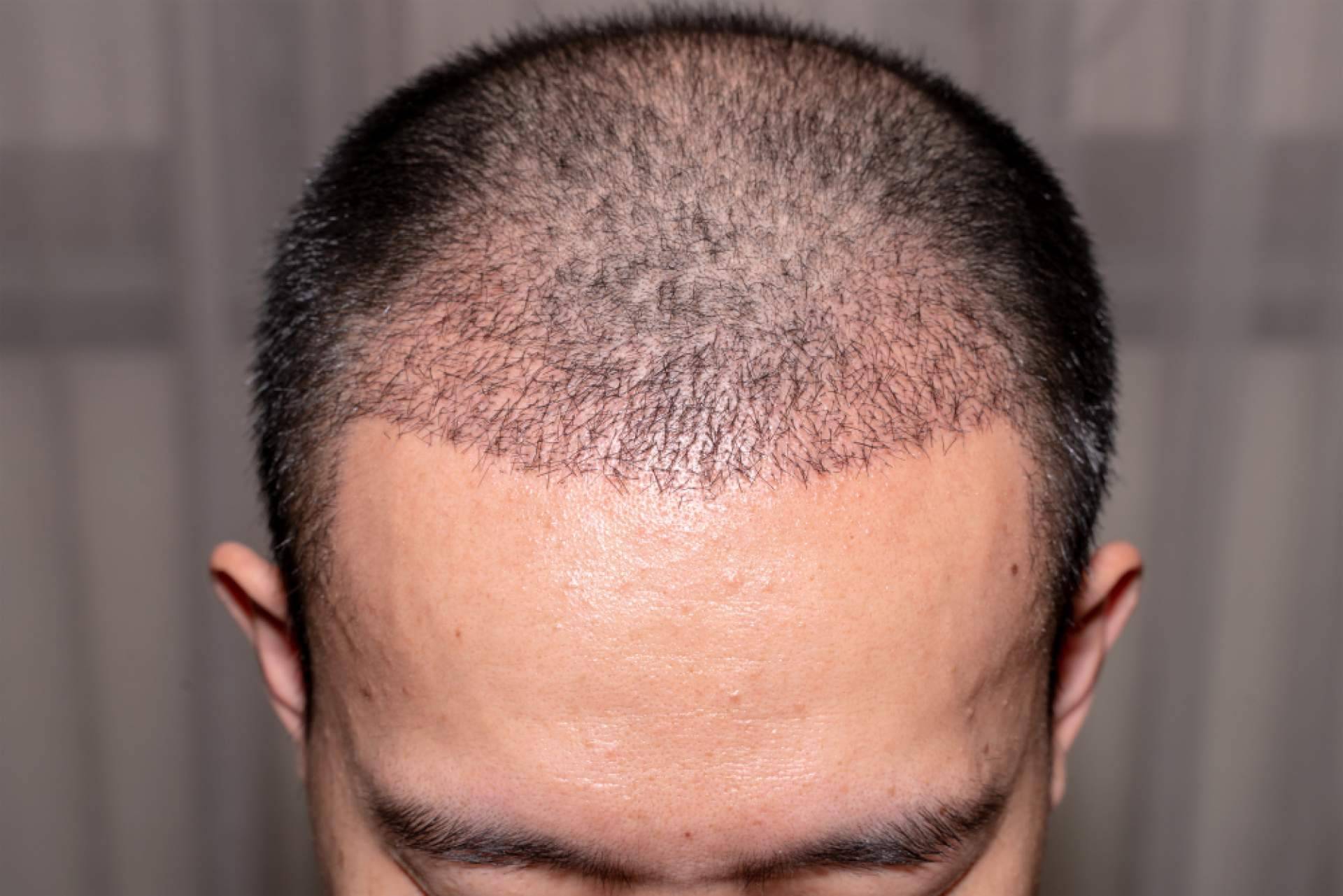 MC360 cuenta con expertos en injertos de pelo