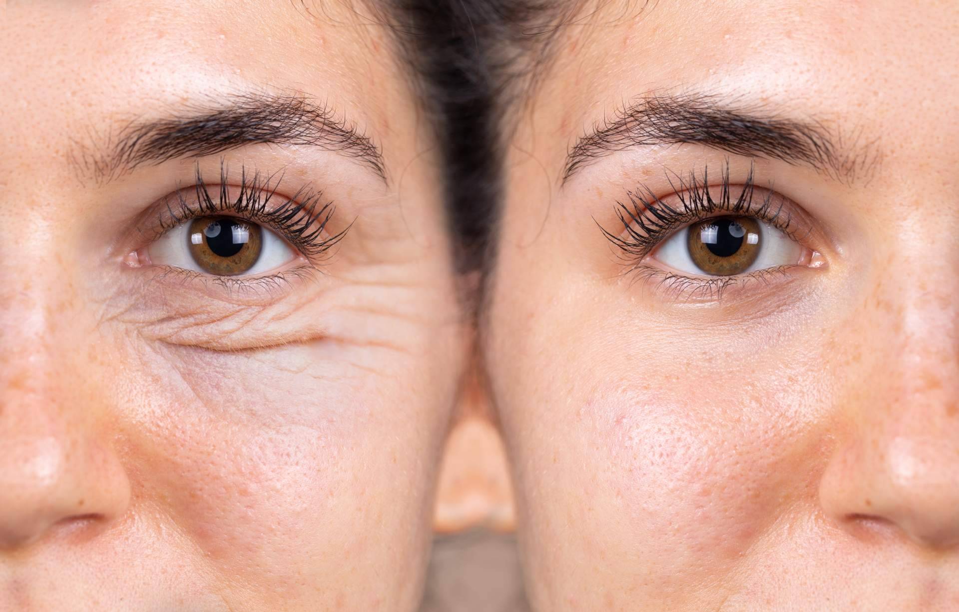 Realizarse una cirugía blefaroplastia con los expertos de Centro Médico El Pilar