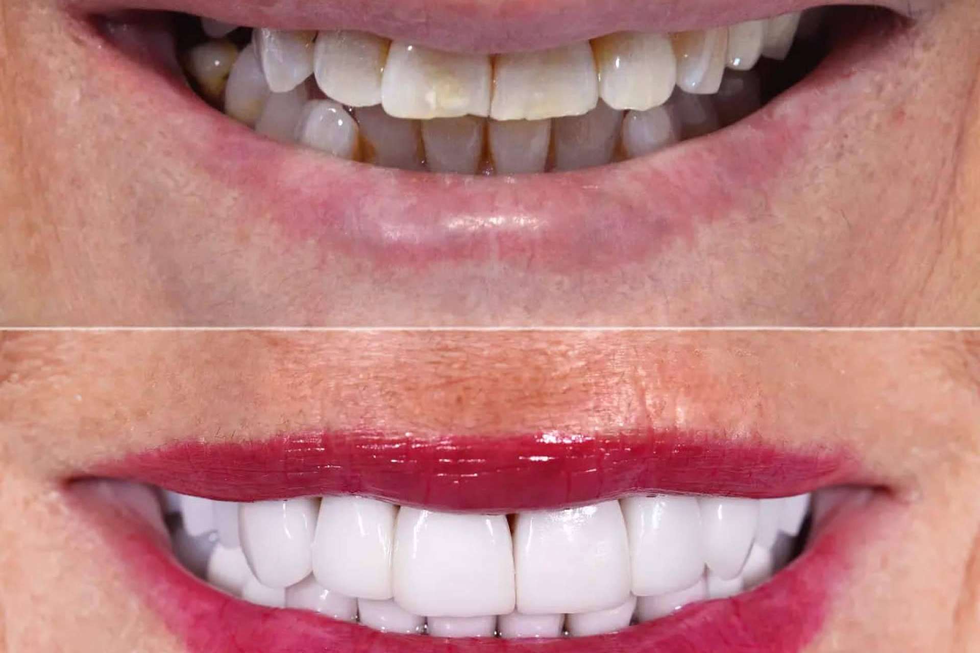 Denty Dent mejora la sonrisa de sus pacientes con tratamientos de estética dental