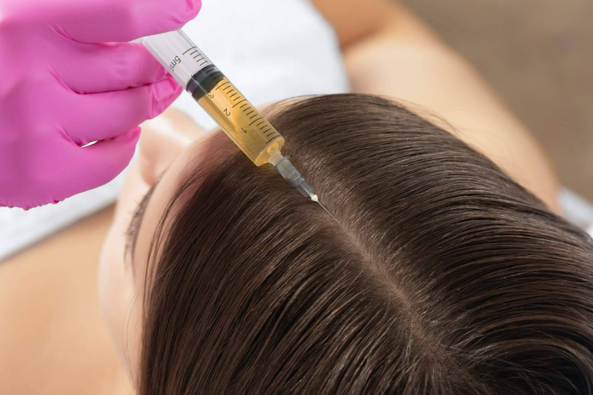Información sobre el tratamiento PRP capilar en el Centro Estética El Pilar