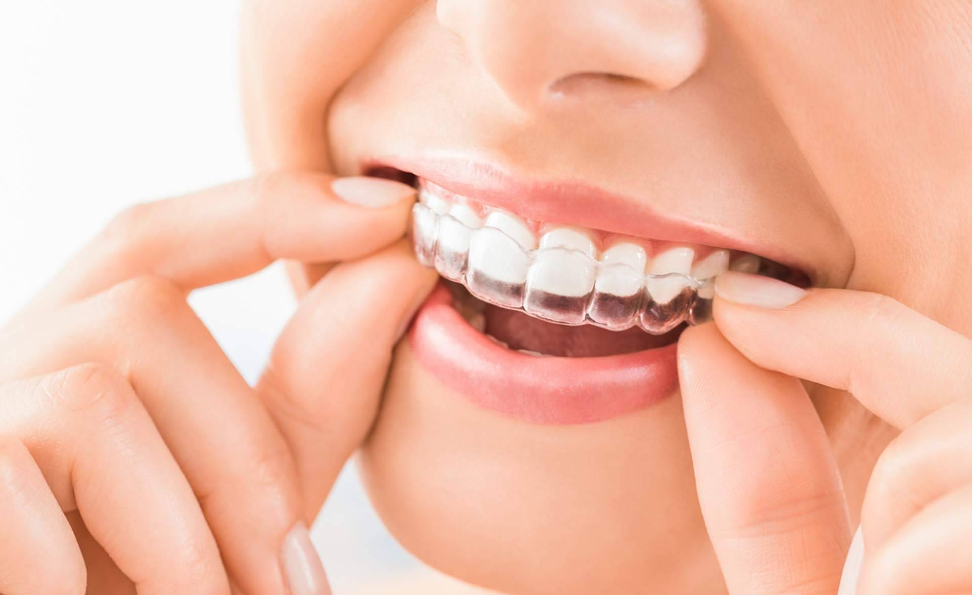 InterORALIA explica los beneficios de la ortodoncia Invisalign