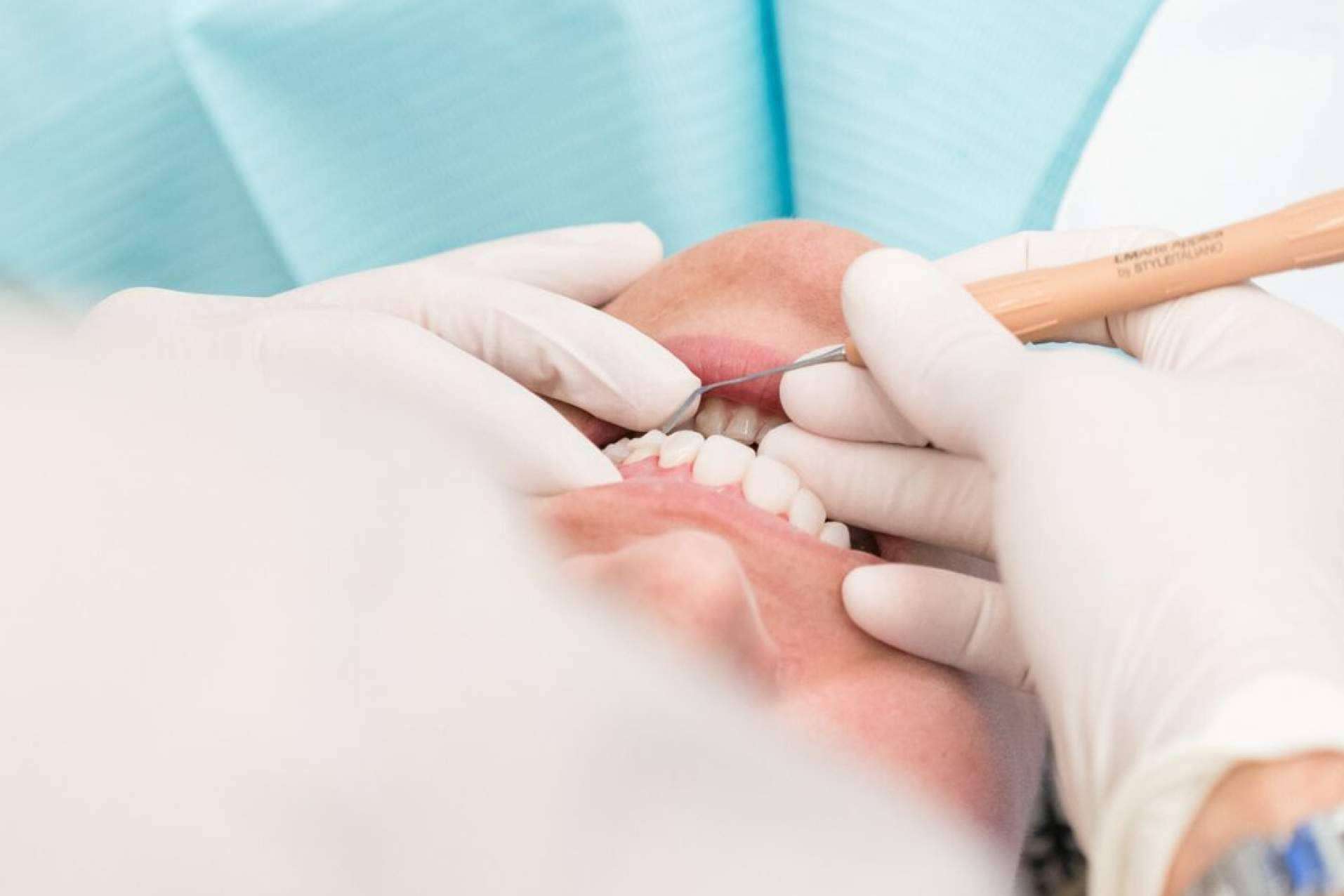 Tratamiento para la gingivitis, de la mano de Clínica Dental Ruiz de Gopegui