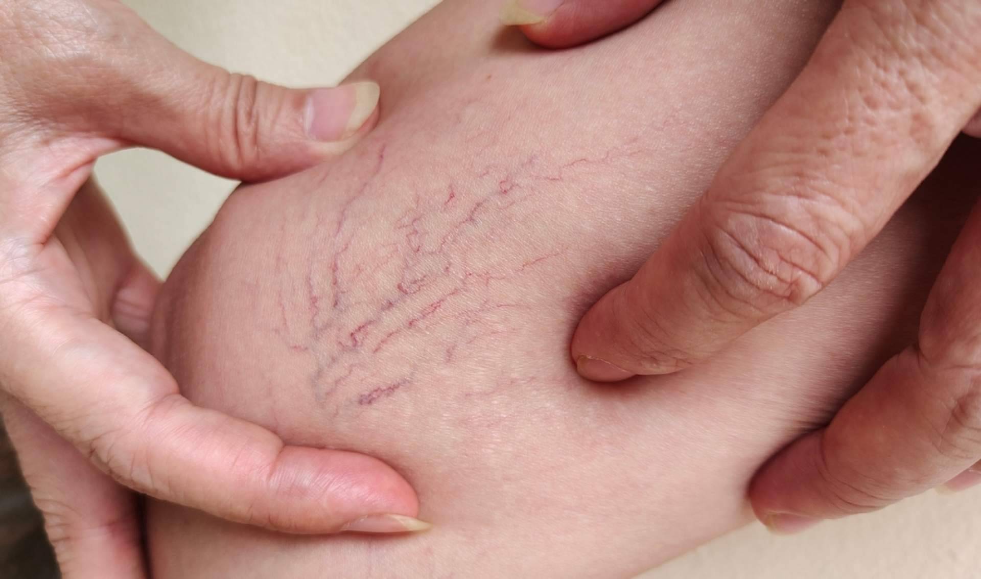 Elegansse, especialistas en la eliminación de varices
