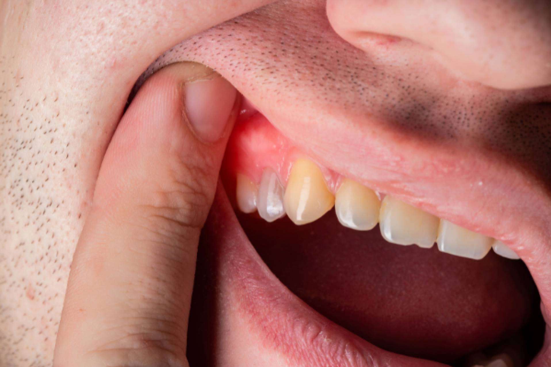 Prevención y tratamiento de enfermedades de las encías, con la clínica Denty Dent