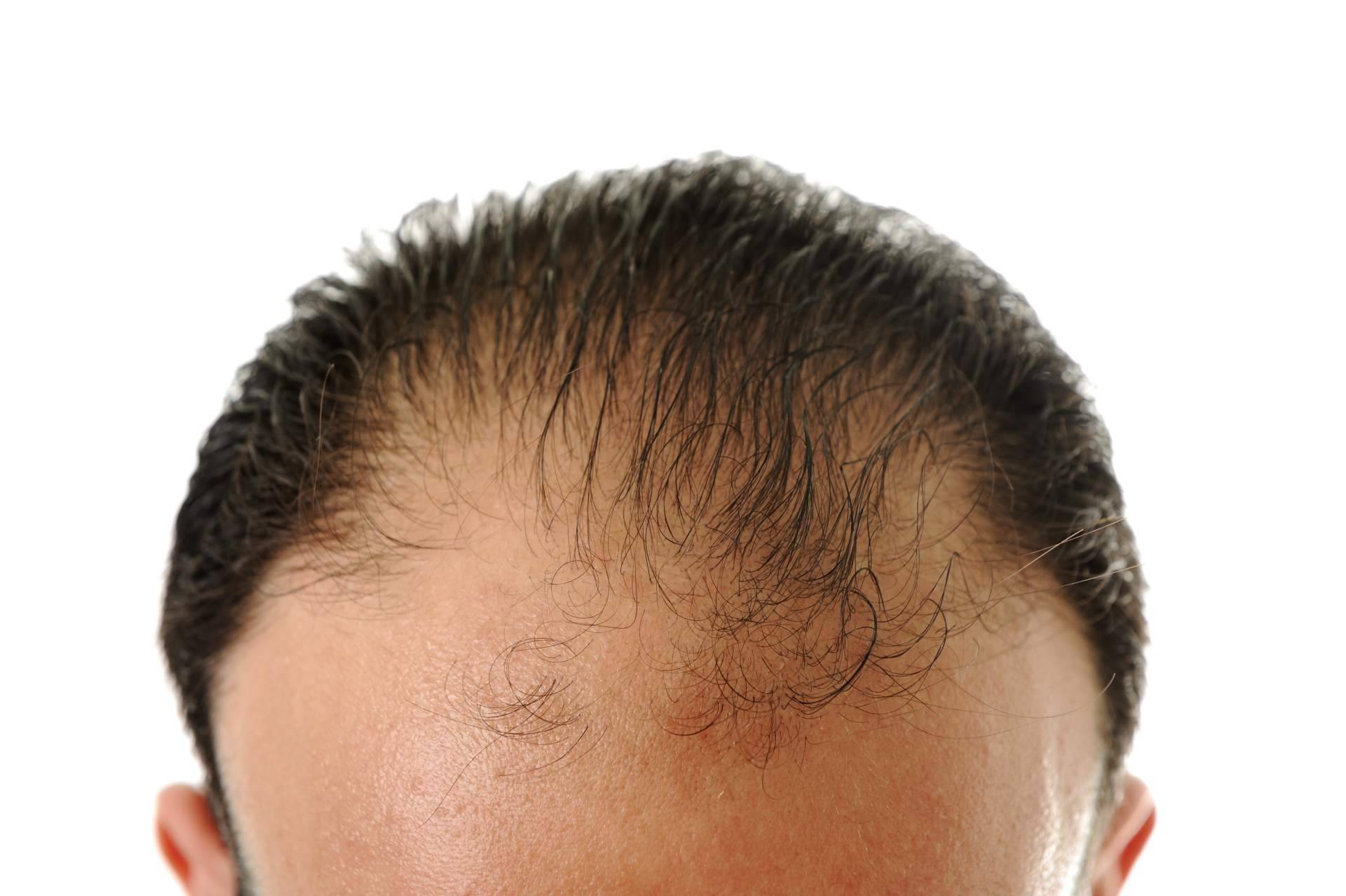 Tratamientos para la alopecia androgénica con Saw palmetto