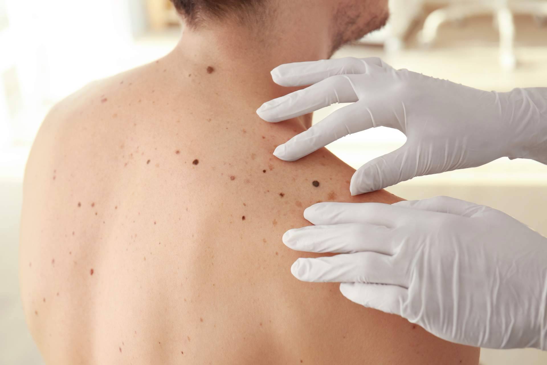 Tecnología de vanguardia para la eliminación de manchas en la piel, en el Centro Estética el Pilar