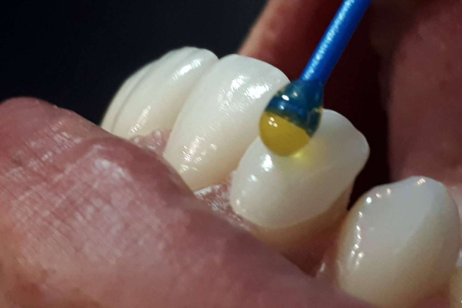 Cómo resolver una nueva sonrisa sin tocar el diente