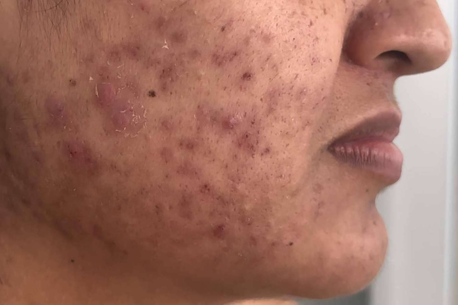 Dra. Janeth Arévalo, especialista en tratamientos para el acné hormonal provocado por el síndrome del ovario poliquístico