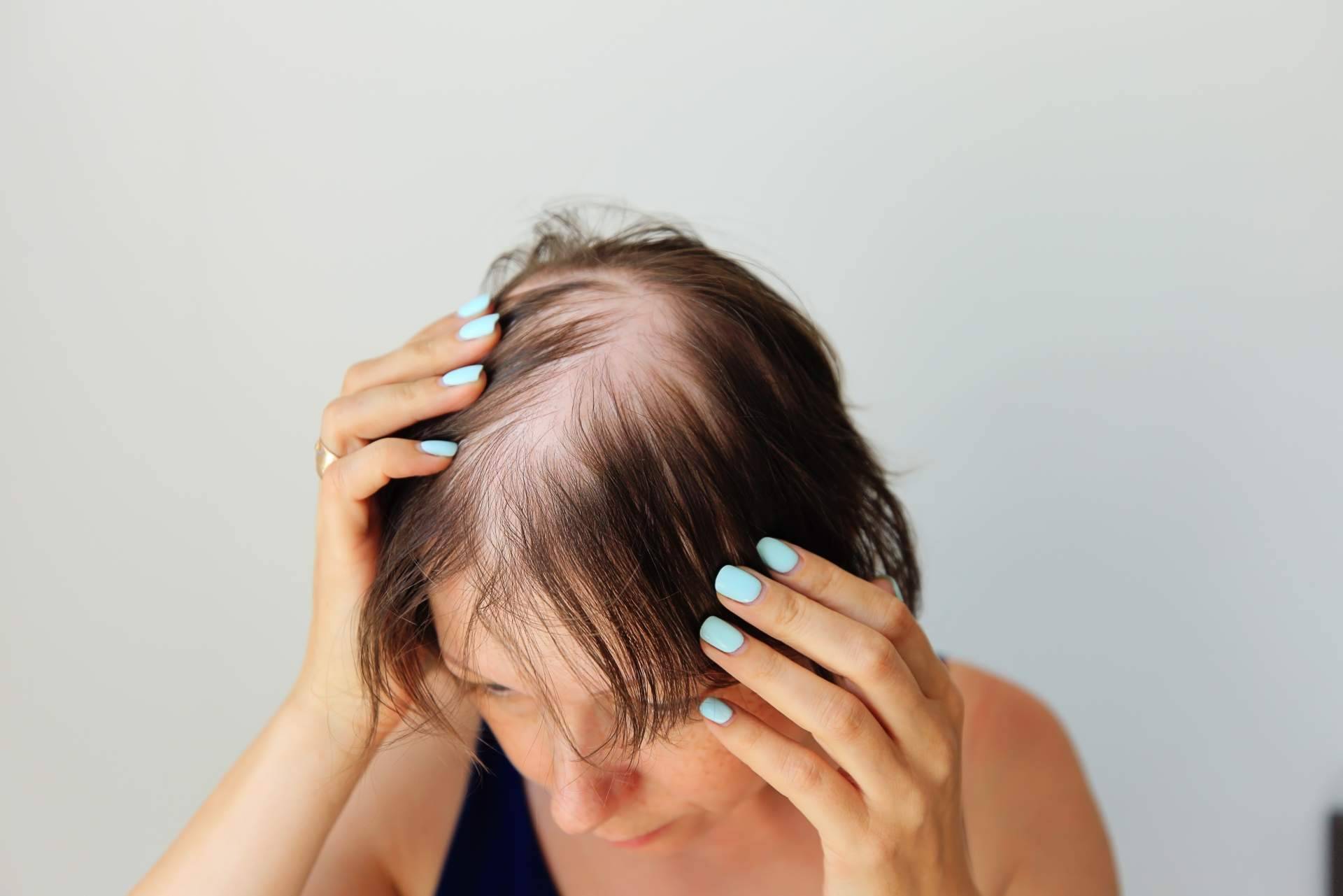 Alopecía androgénica; cómo afecta la caída del cabello a hombres y mujeres, por el Institut Mèdic DaVinci
