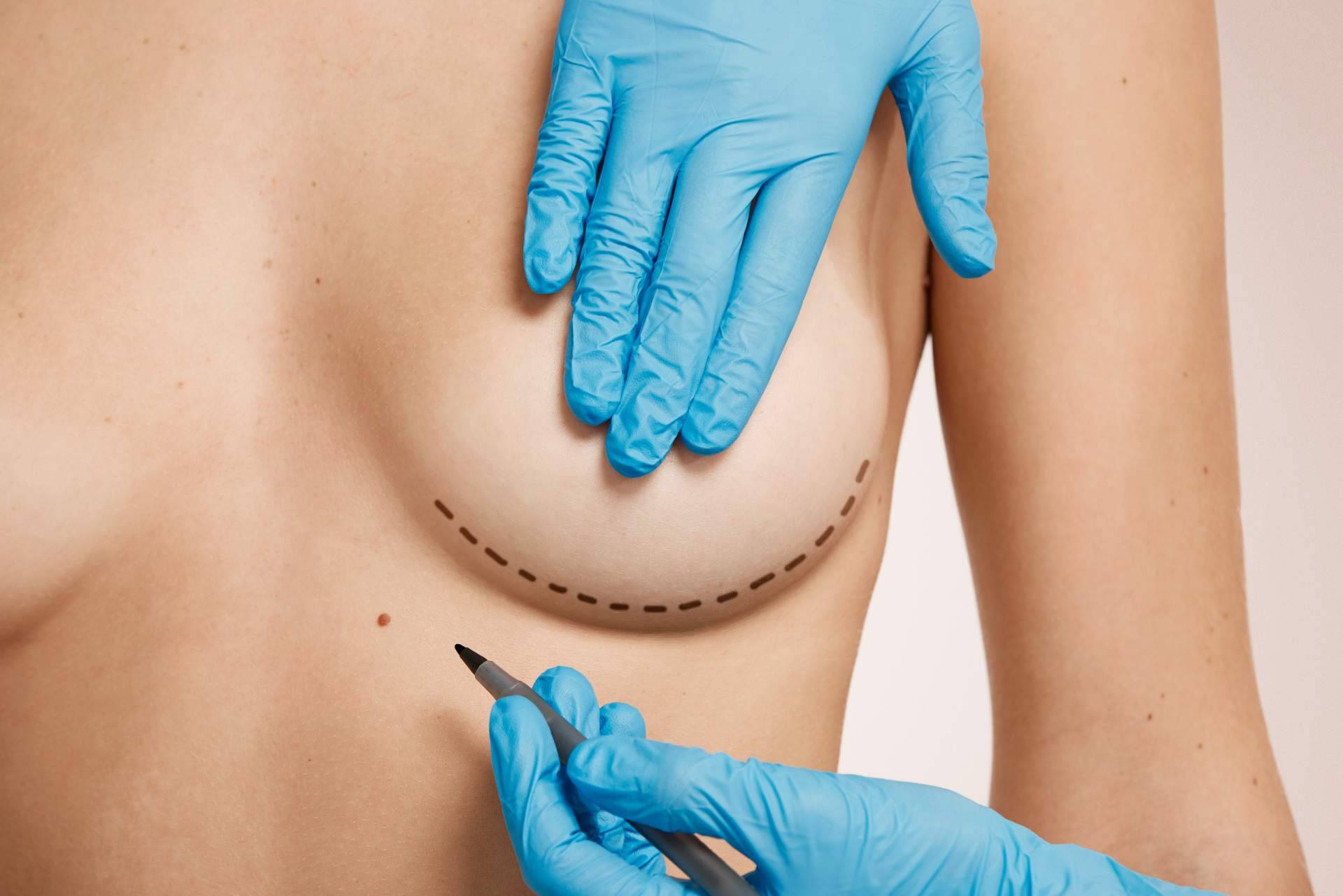 Las clínicas Beauty&Beauty son una referencia en mastopexia y cirugía de elevación de pecho
