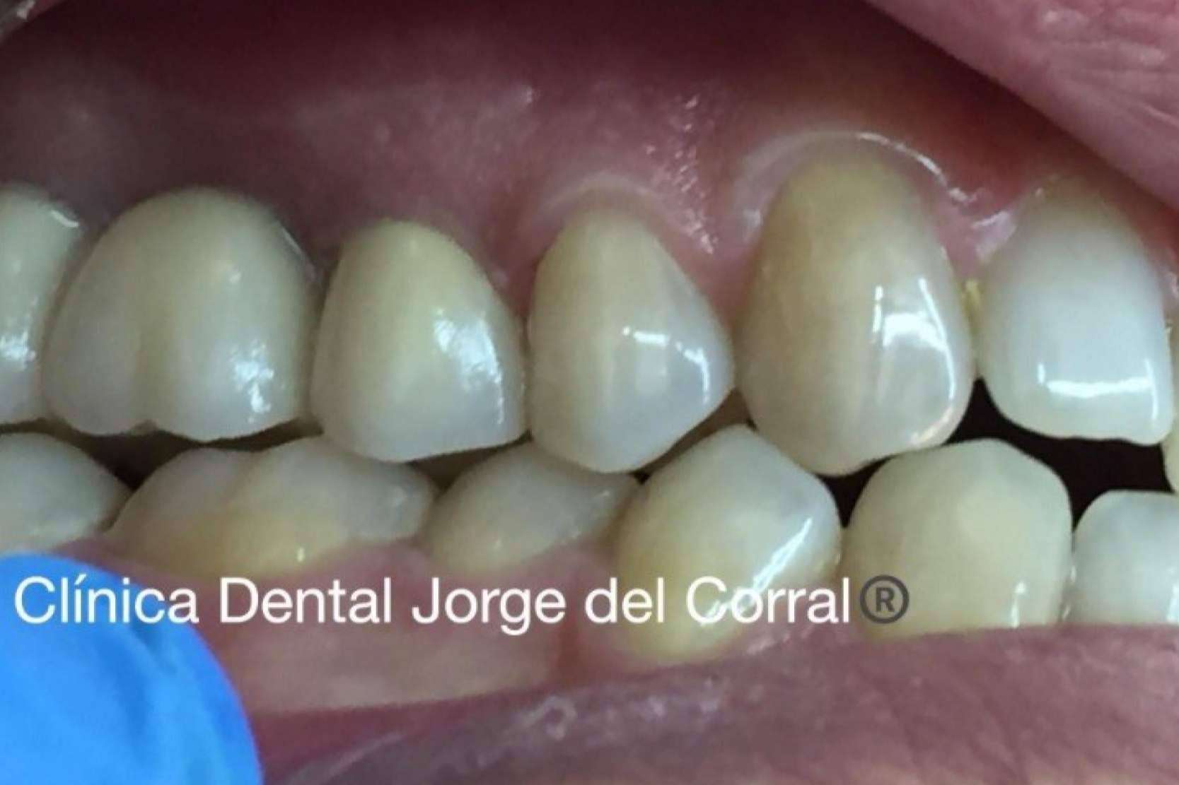 Clínica Dental Jorge del Corral en Hortaleza, Madrid; calidad en prótesis fija estética de zirconio