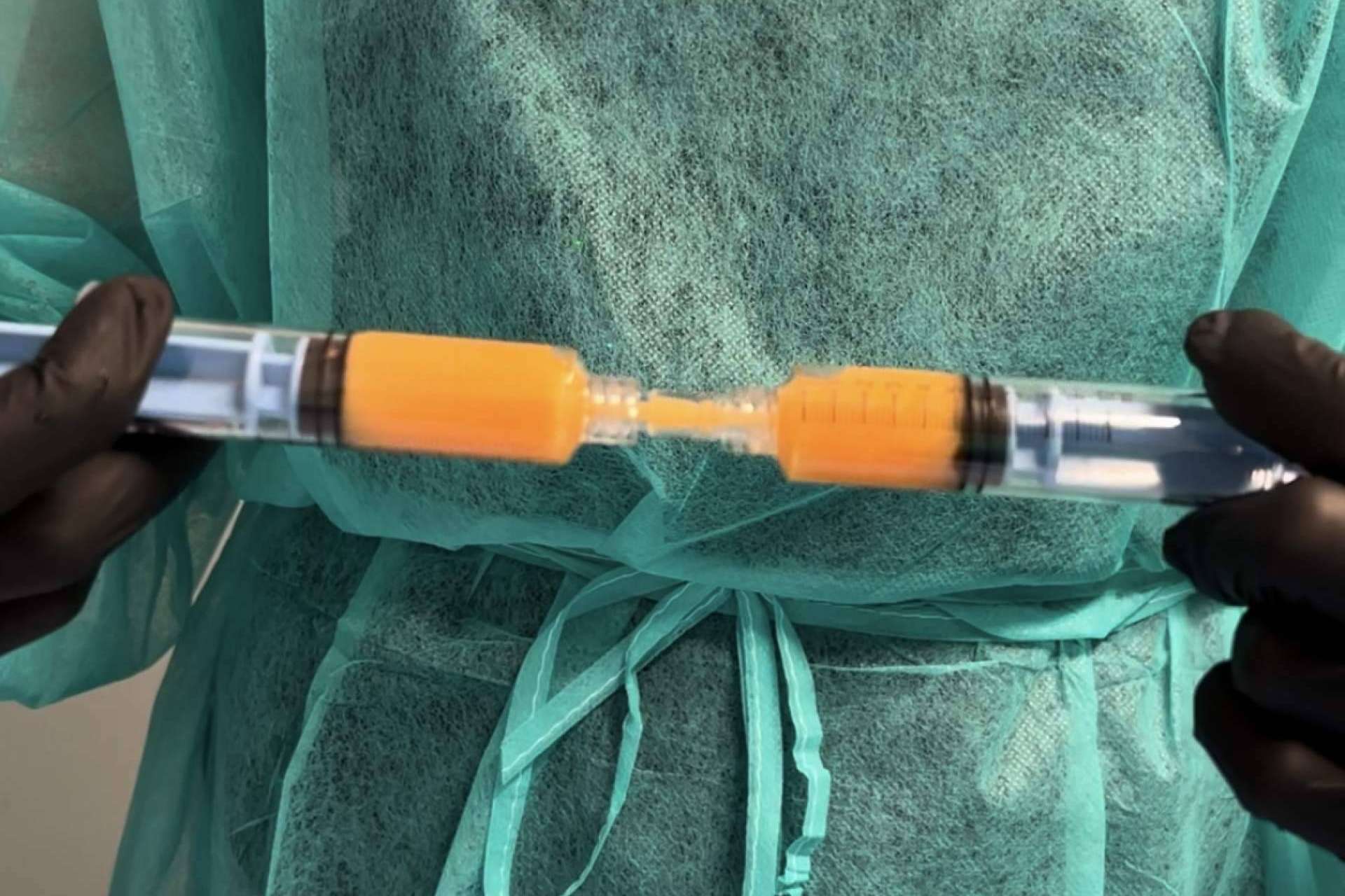 SEFFILLER®️ llega a MD Cliniques; regeneración cutánea con tejido graso propio