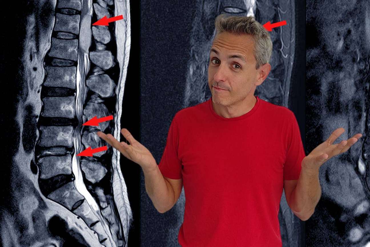 El método de Roberto Galván para ganar la batalla a las molestias derivadas de la hernia discal L5-S1