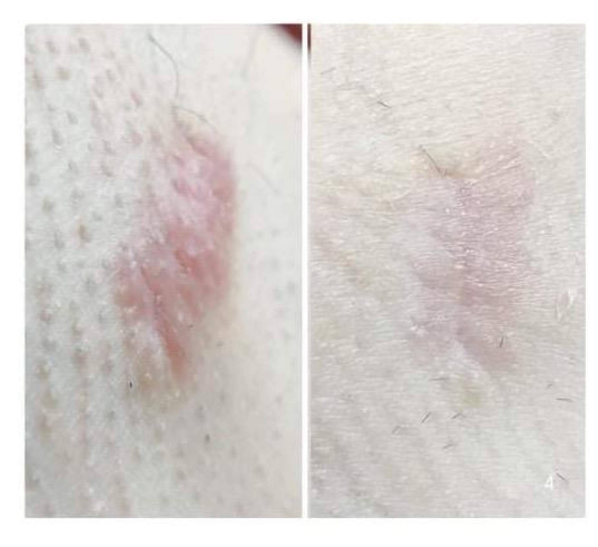 Cicatrices en Barcelona, abordaje profesional de cicatrices quirúrgicas, de acné e hipertrofias